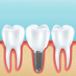 Korsadent Integra-Tapered (KT) Implant